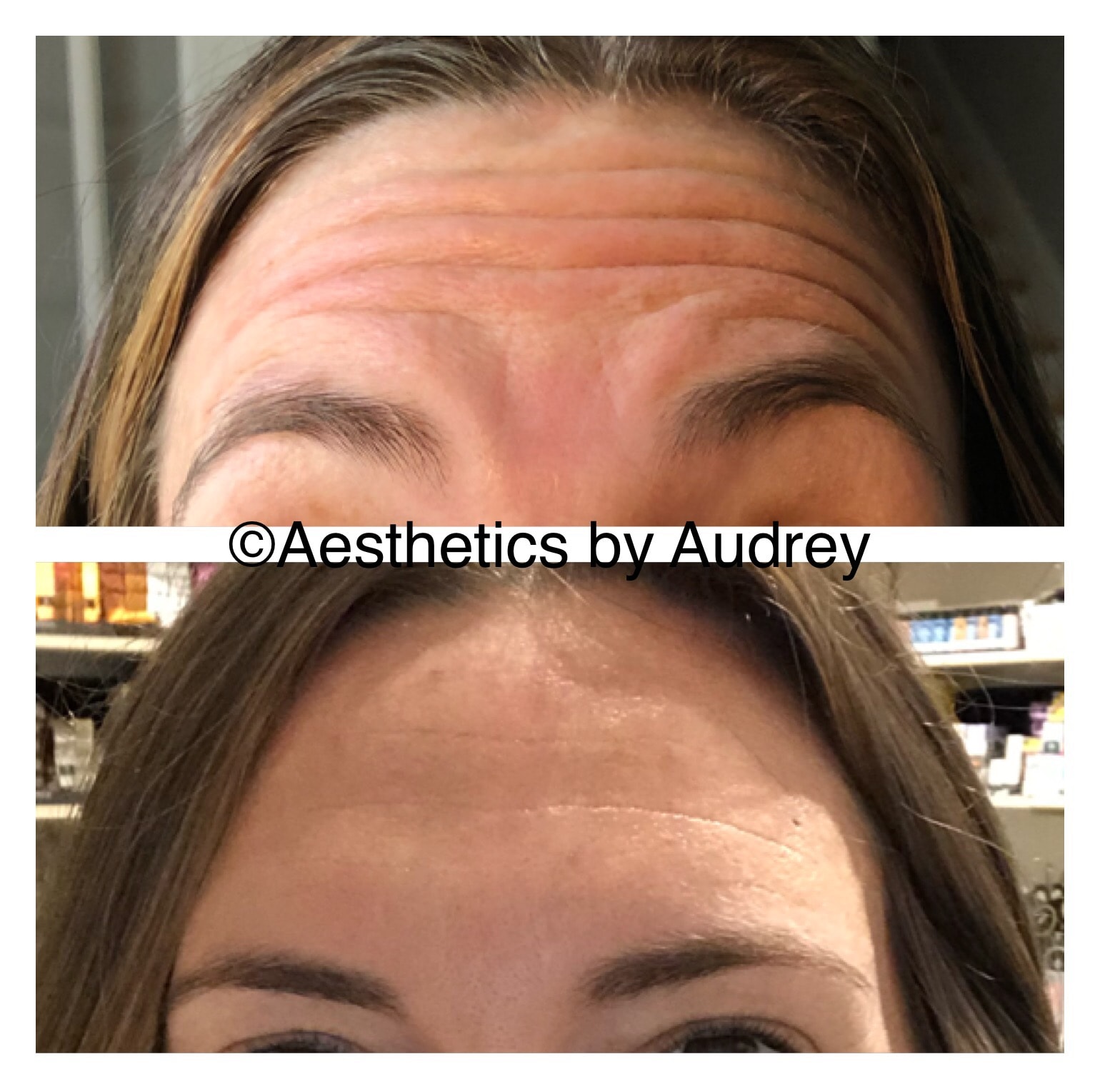 Botox — Forehead Lines