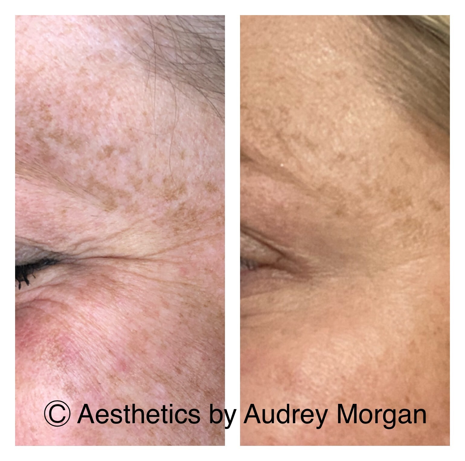 Botox — Crow's Feet