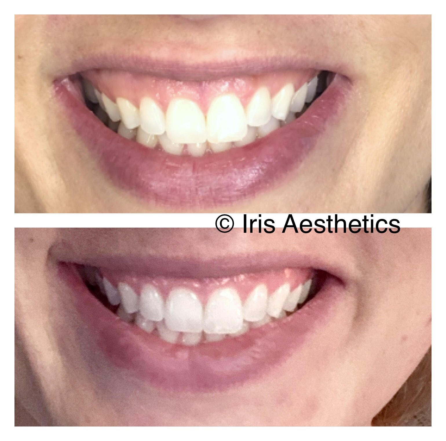 Botox — Lip Flip