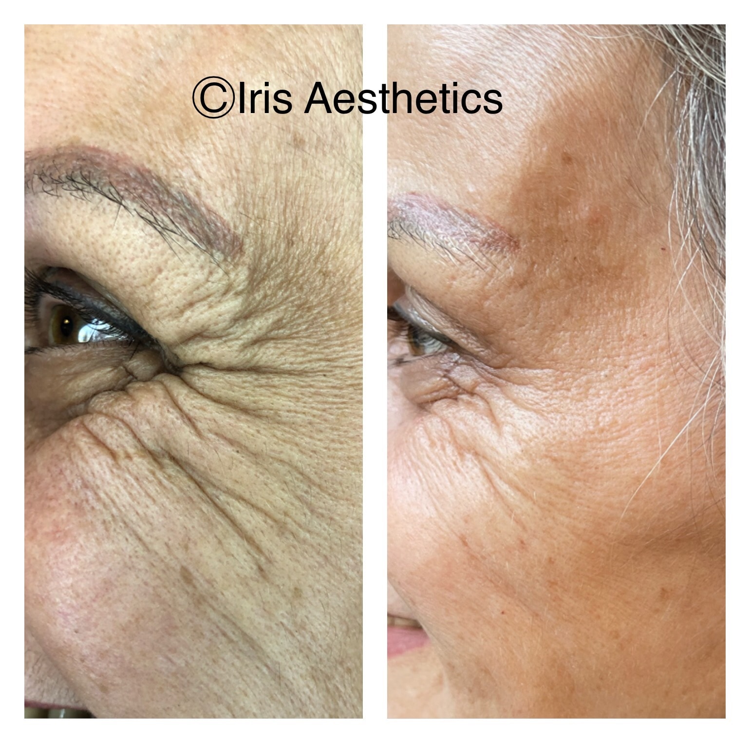 Botox — Crow's Feet