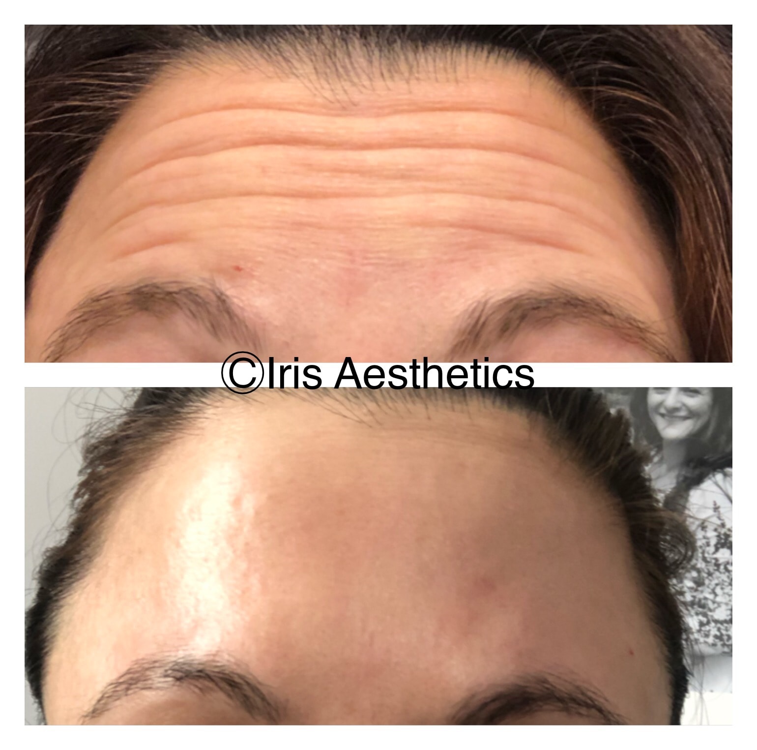 Botox — Forehead Lines