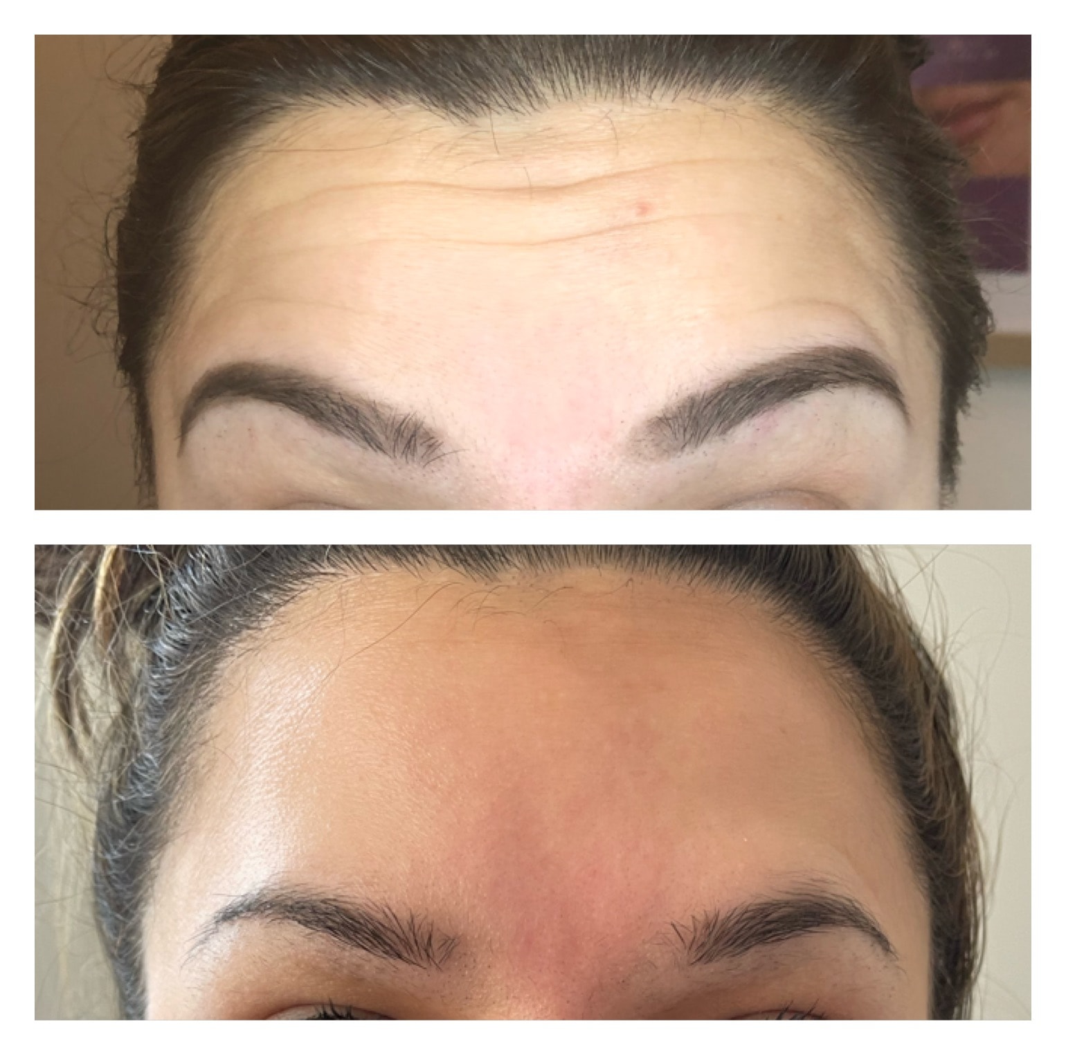 Botox — Forehead Lines