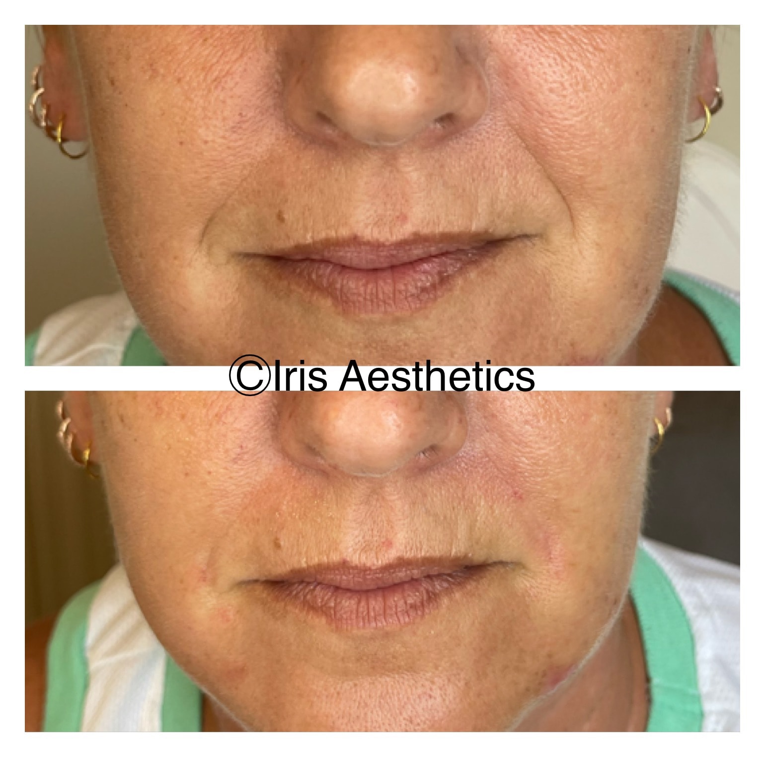 Lip Filler — Front View