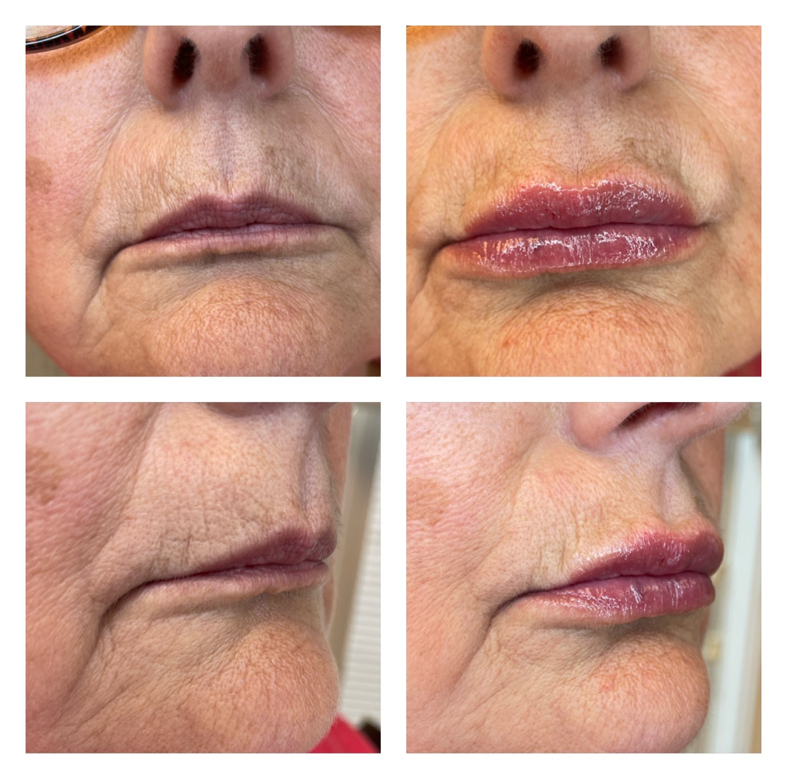 Perioral Filler