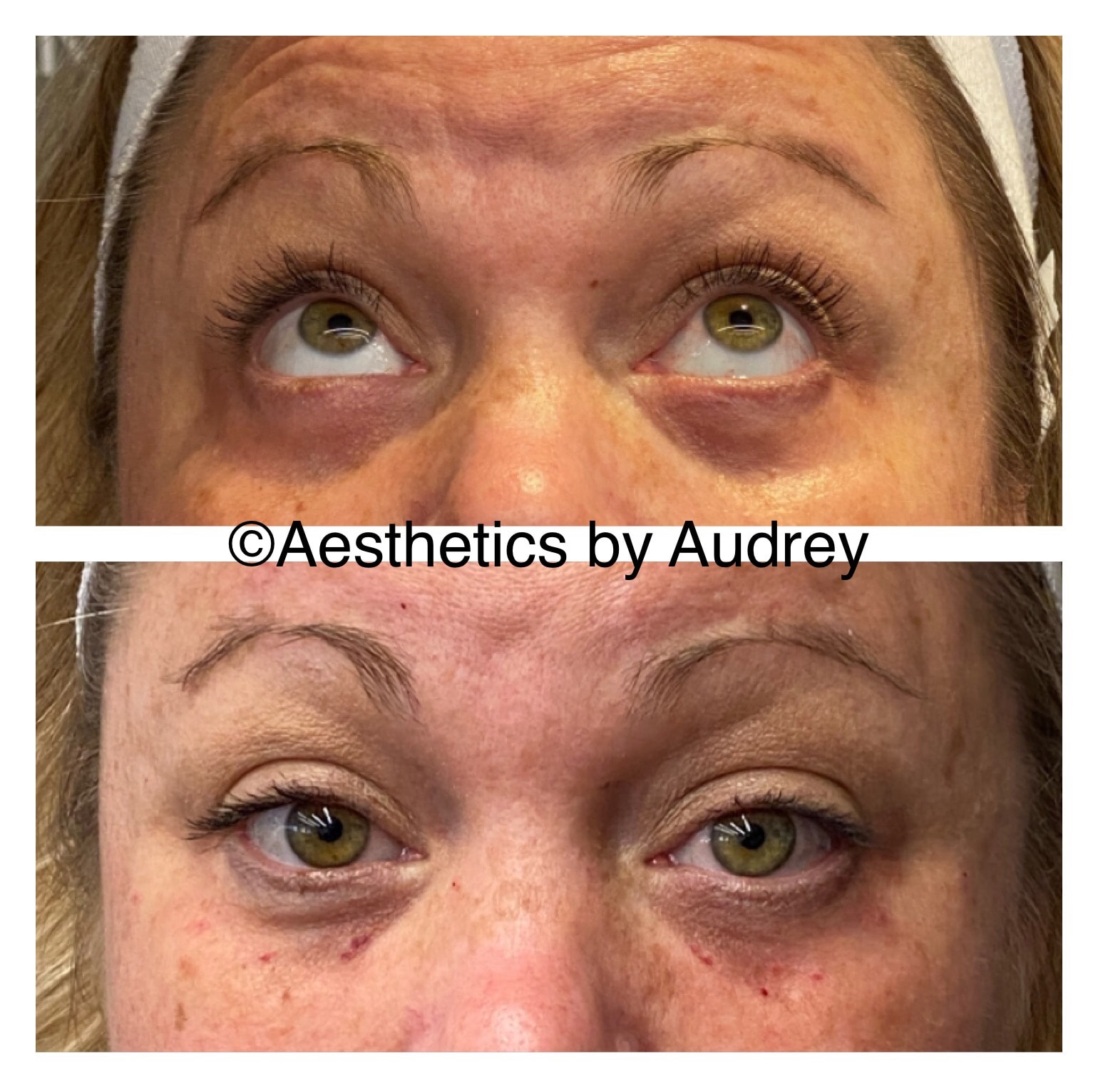 Under-Eye Filler — Tear Trough
