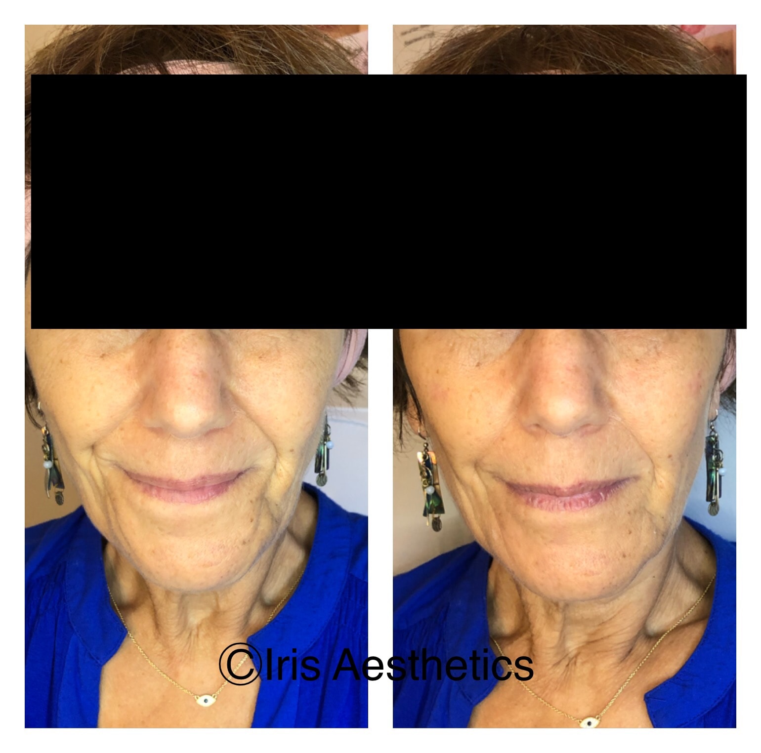 Facial Volume Restoration