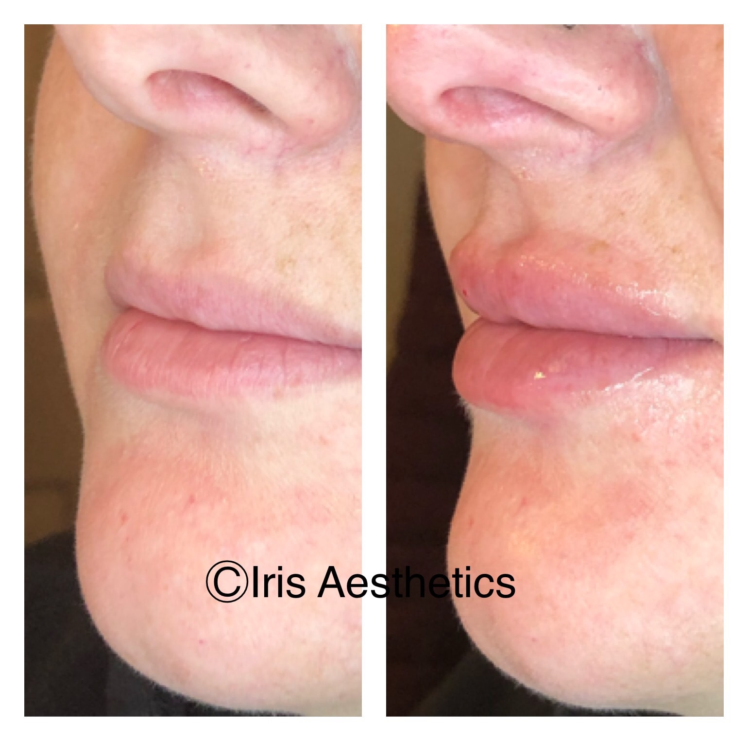 Lip Filler — 3/4 Angle